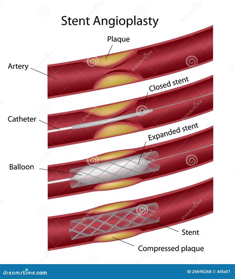 Stent Angioplasty Royalty Free Stock Photos - Image: 26696268