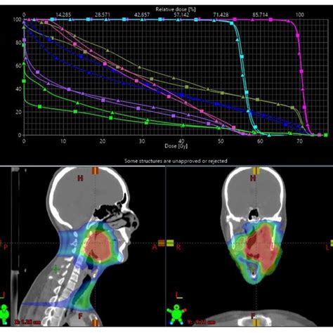 Comparison Of Dose Distribution And Dose Volume Histograms DVH For