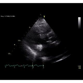 Transthoracic echocardiogram views. Four standard views that show a... | Download Scientific Diagram