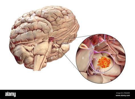 Pituitary Gland Tumour Illustration Stock Photo Alamy