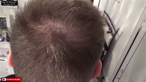 Fue Hair Transplant Day 76 Post Op Recovery Youtube