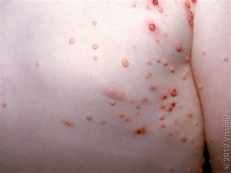 Molluscum Contagiosum Symptoms And Treatment With Images Goodrx