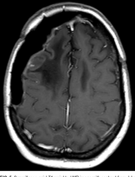 Figure From Anaplastic Meningioma Octreotide Therapy For A Case Of