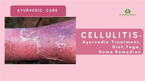 Ayurvedic Treatment For Cellulitis Natural Relief For Healing