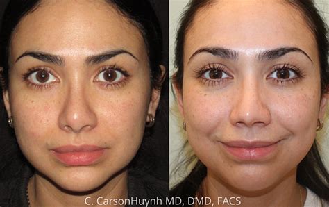 Rhinoplasty Archives Radiance Surgery Aesthetic Medicine