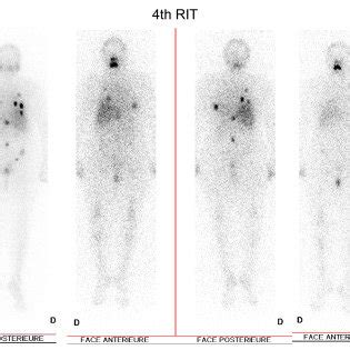 Whole Body Radioactive Iodine Rai Scan After The First A And Second