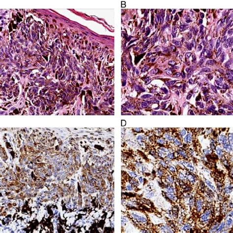 PDF The Amount Of Melanin Influences P16 Loss In Spitzoid Melanocytic