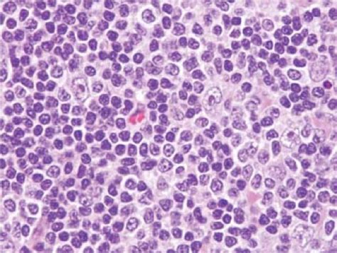 Hodgkin Lymphoma Nodular Lymphocyte Predominant Basicmedical Key