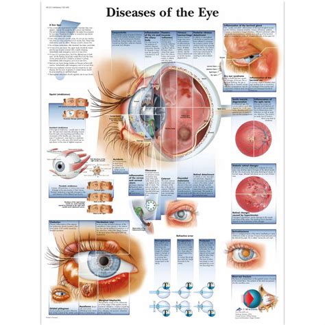 Diseases of the Eye Chart - MedicalSupplies.co.uk