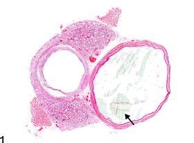 Esophagus Dilation Nonneoplastic Lesion Atlas Hot Sex Picture