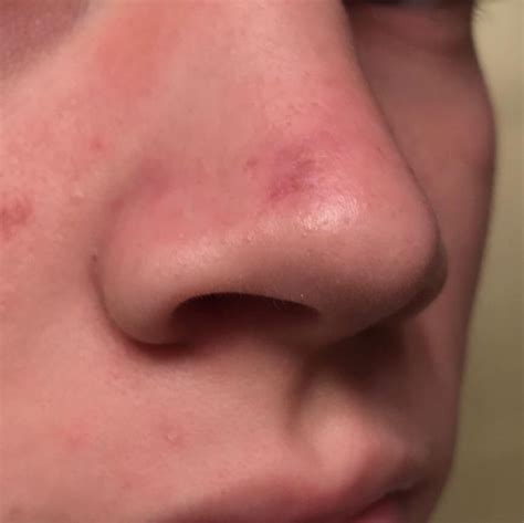 Pimple Scars On Nose