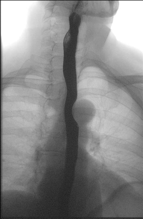 Figure Single Frontal Image Taken During A Barium Swallow Exam