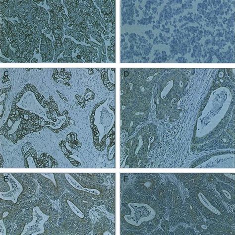 Immunohistochemical Staining Of The Igf Ir Positive Mcf 7 Cell Pellet