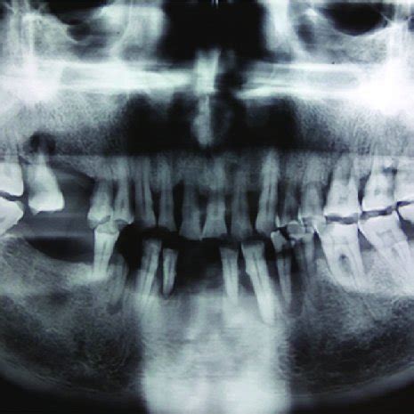 (PDF) Stafne bone cyst: A case report with review of literature