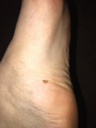 Dark Spots On Side Of Foot Outlet Emergencydentistry