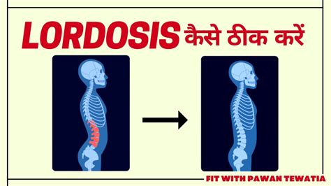 How To Fix Back Posture Lordosis How To Cure Lower Back Pain