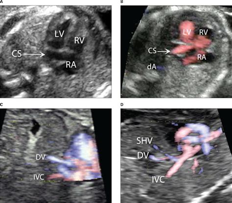 Aberrant Drainage Of The Umbilical Vein Into The Coronary Sinus Without