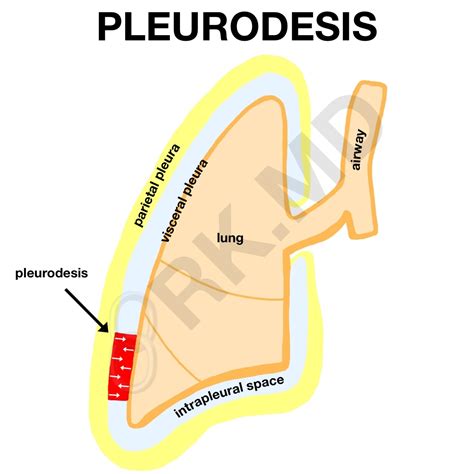 What Is Pleurodesis? | RK.MD