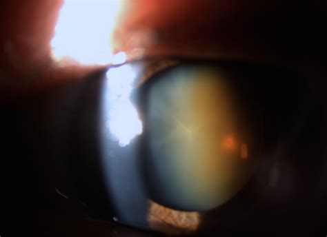 Approach To The Dense Brunescent Cataract Cataract Coach