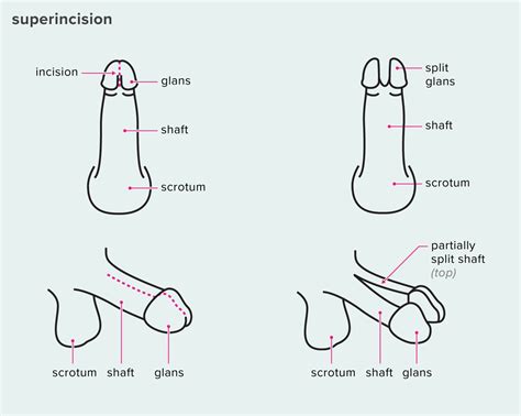 Subincision Penis Telegraph