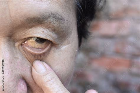 Pale skin of Asian man. Sign of anemia. Pallor at eyelid. Stock Photo ...