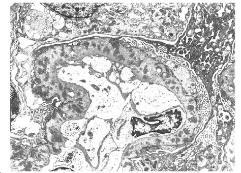 Electron Microscopy Image Showing Granular Electron Dense Deposits