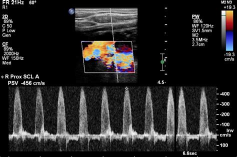 Subclavian Artery Waveform Ultrasound