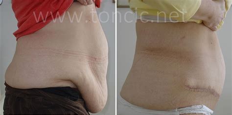 Abdominoplasty Photo Gallery Dr Toncic Clinic