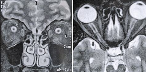 Papilledema Mri