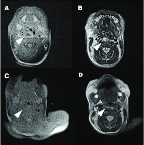 Magnetic Resonant Imaging Mri Of The Neck A B White Arrowhead The