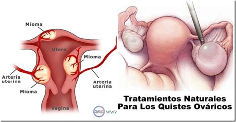 Remedios Naturales Para Eliminar Los Miomas Y Quistes