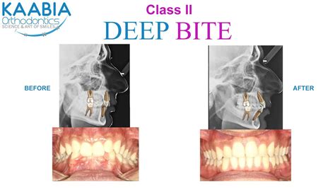 Class 2 Deep Bite Classe 2 Supraclusie Youtube