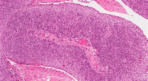 HPV-associated squamous cell carcinoma of the oropharynx | Atlas of ...