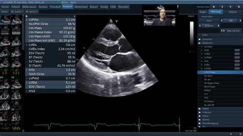 Standardisierte Echokardiographie Normabefund Youtube