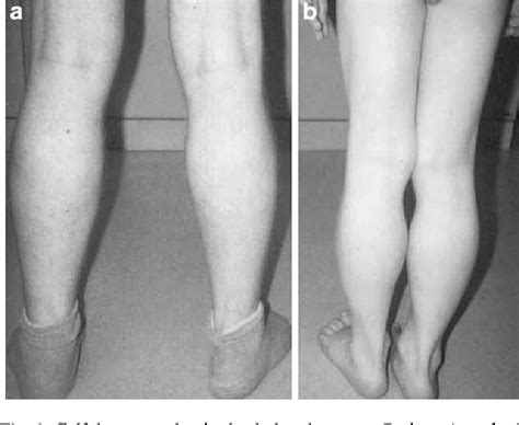 Limb Girdle Muscular Dystrophy Type I Caused By A Novel Missense