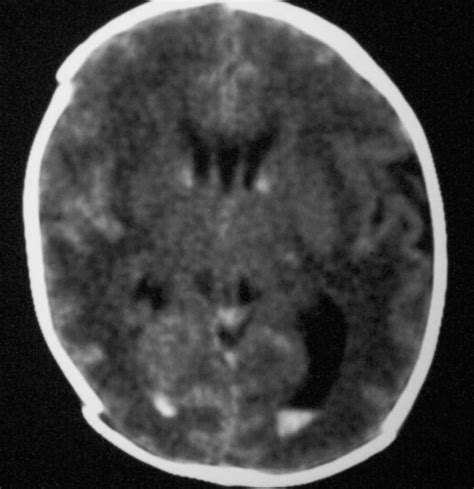 Germinal Matrix Hemorrhage Causes Symptoms Diagnosis Treatment