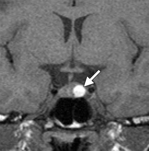 Intracranial Lesions With High Signal Intensity On T1 Weighted Mr