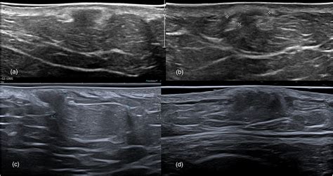 Lipoma Ultrasound Treatment - Infoupdate.org