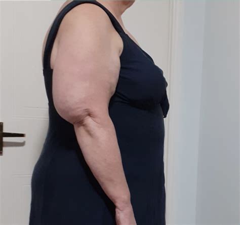 Lipedema Vs Cellulite Lipedema Stages And More