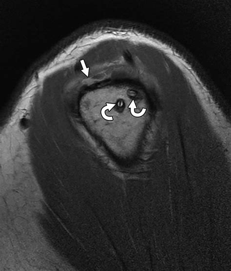 Multimodality Imaging Review Of Normal Appearance And Complications Of The Postoperative Rotator