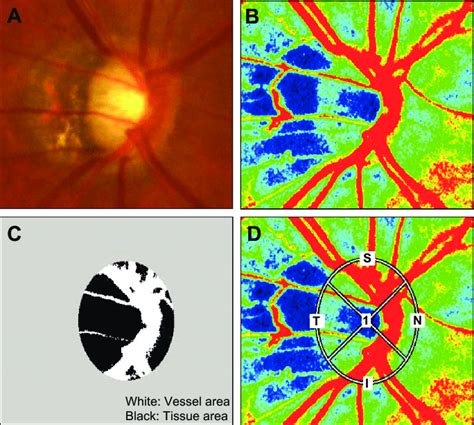 A A Fundus Photograph Showing A Typical Myopia Type Optic Disk The