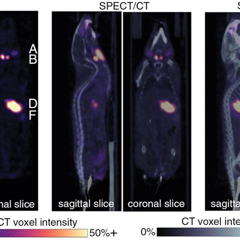 SPECT SPECT CT And Maximum Intensity Projections MIP Of SPECT CT