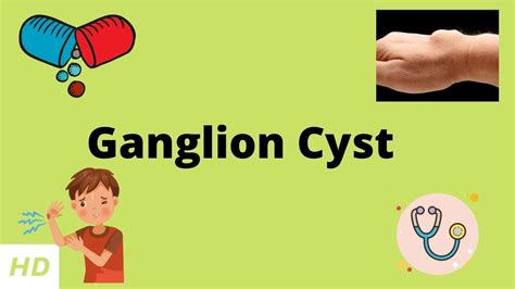 Ganglion Cyst Causes Sign And Symptoms Diagnosis And Treatment