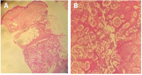 Pancreatitis Panniculitis And Polyarthritis Ppp Syndrome Bmj Case Reports