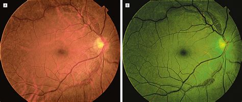 Paravascular Inner Retinal Cleavage In A Highly Myopic Eye Ophthalmic