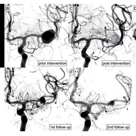 Pdf Endovascular Treatment Of Intracranial Aneurysms In Small