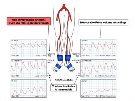 High Ankle Brachial Index What Does It Mean How Is It Used