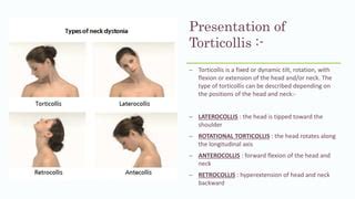 Torticollis And Its P T Management Ppt