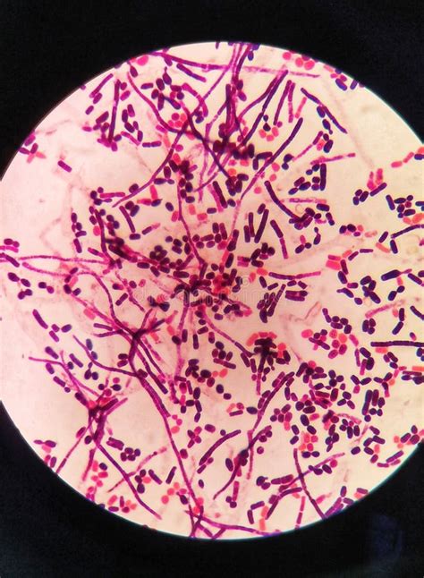 Yeast Cells And Hyphae In Gram Stain Fine With Microscope Stock Photo