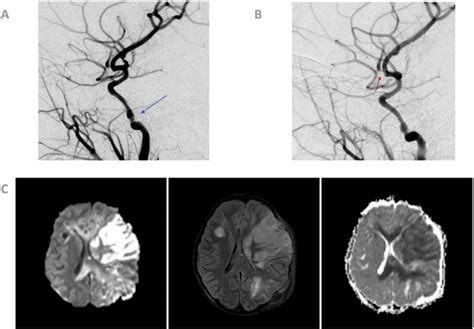 Cerebrovascular Complications Of Pediatric Blunt Trauma Pediatric